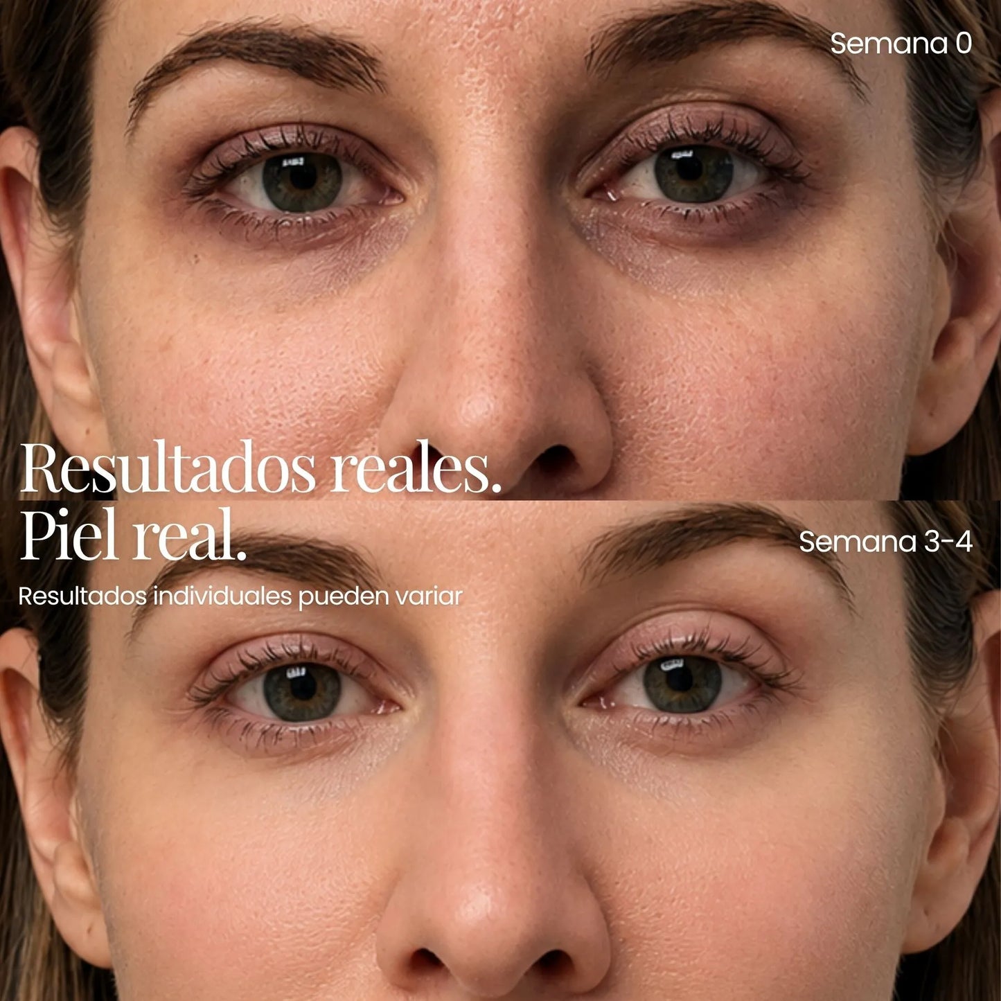 Tecnología ReGen Infusion™