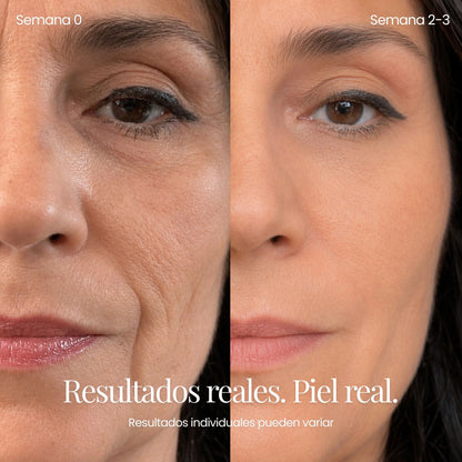 Tecnología ReGen Infusion™