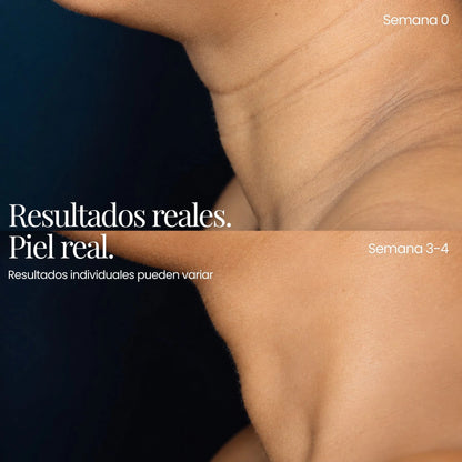 Tecnología ReGen Infusion™