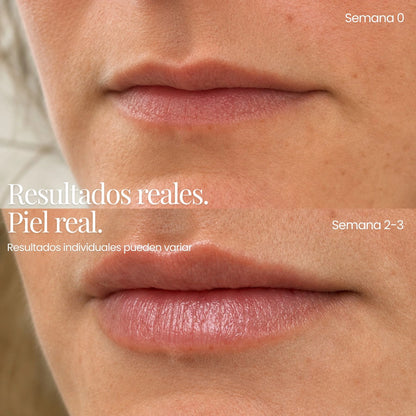 Tecnología ReGen Infusion™