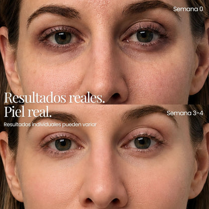 Tecnología ReGen Infusion™