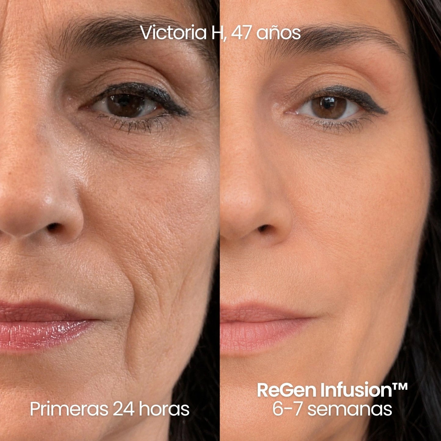 Tecnología ReGen Infusion™