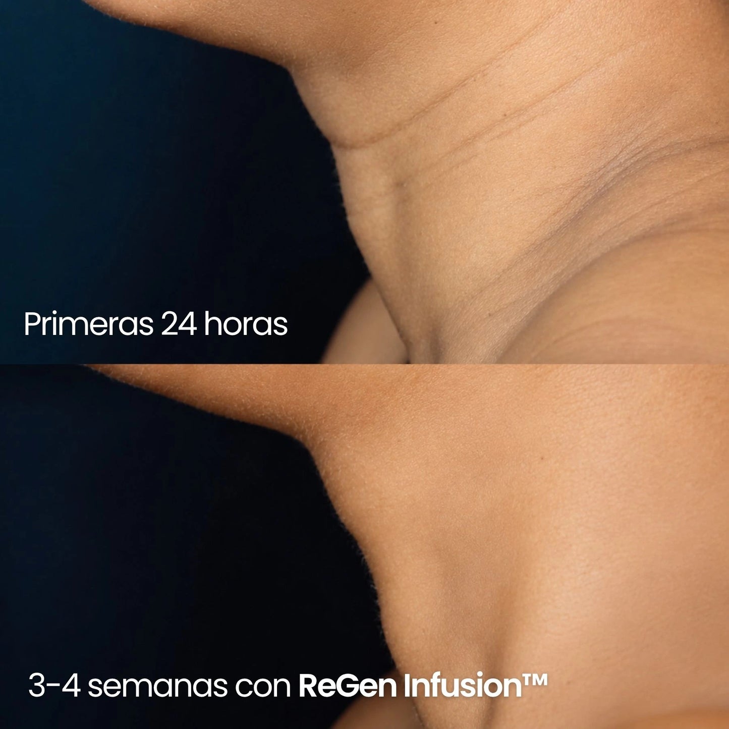 Tecnología ReGen Infusion™
