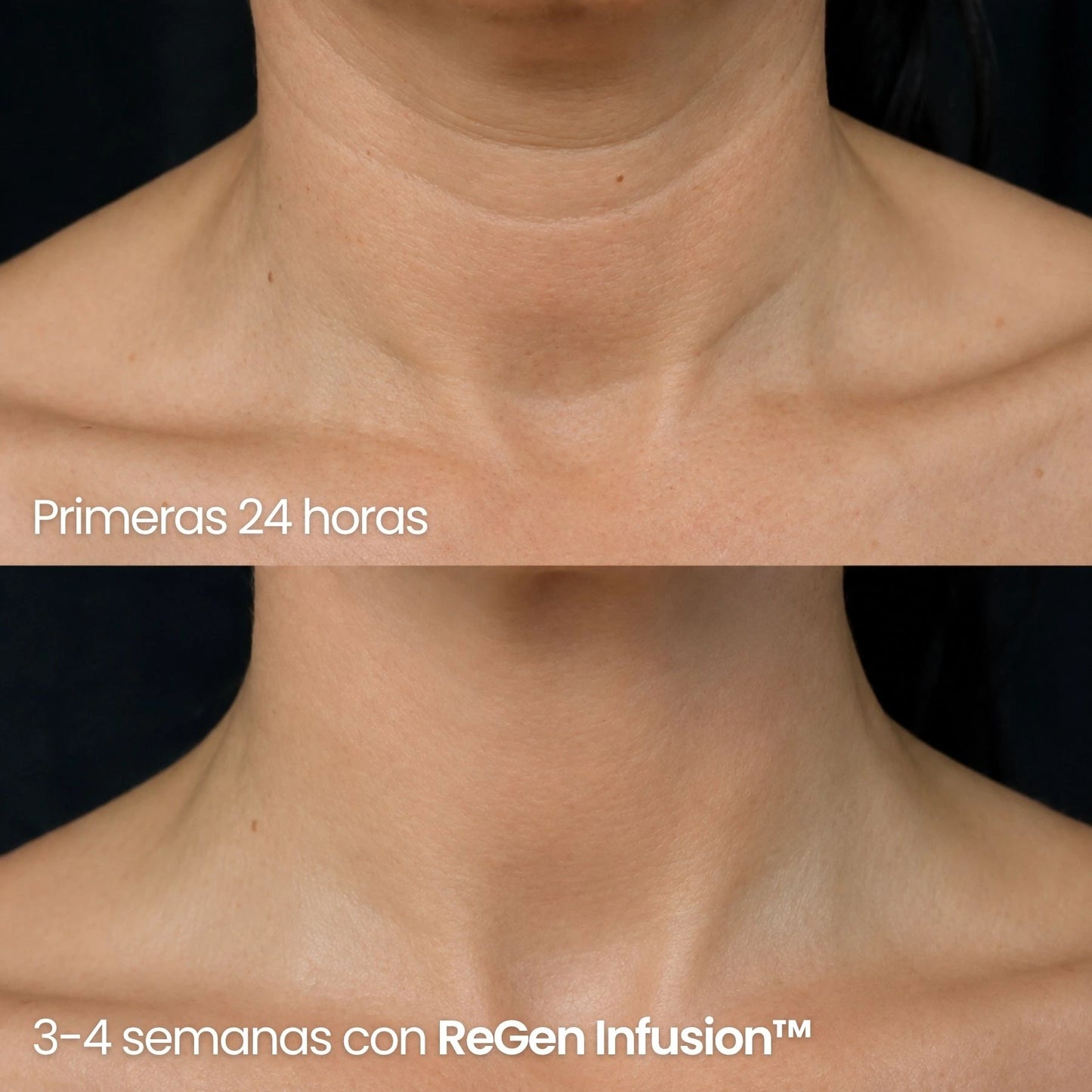 Tecnología ReGen Infusion™