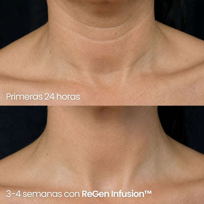 Tecnología ReGen Infusion™