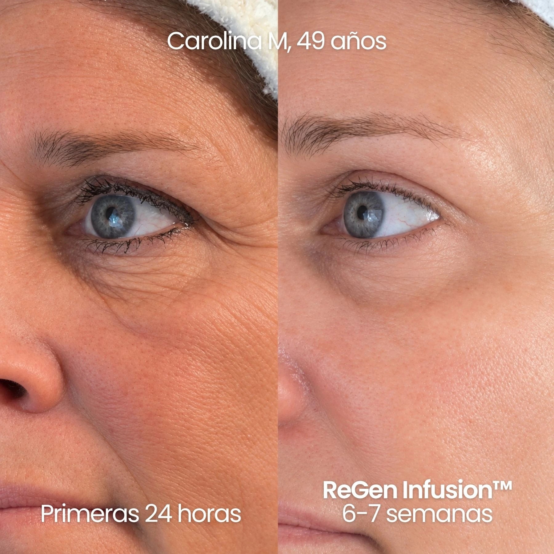 Tecnología ReGen Infusion™