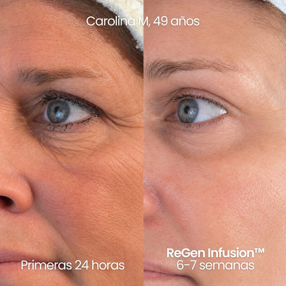 Tecnología ReGen Infusion™