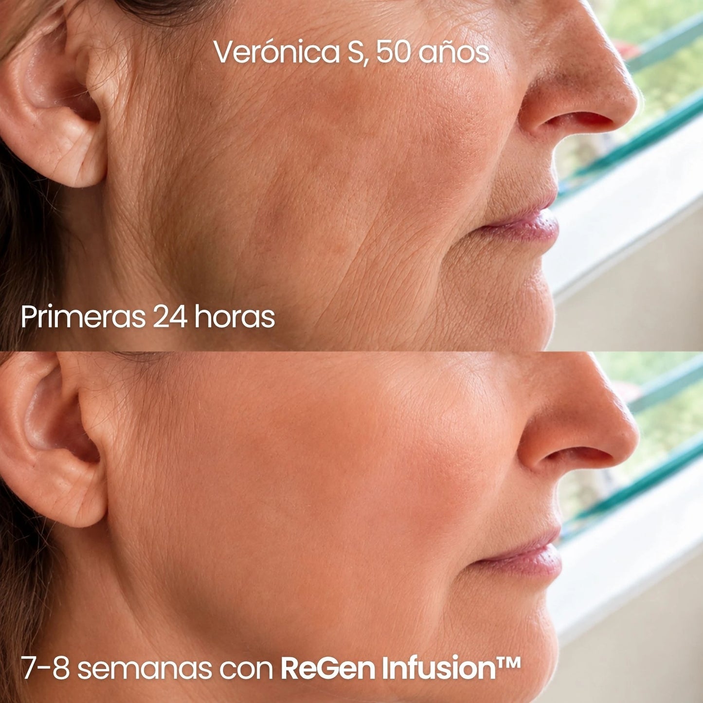 Tecnología ReGen Infusion™